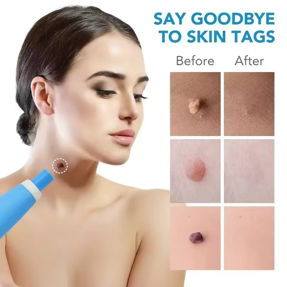 KIT REMOVEDOR ✅ ¡Elimina verrugas y marcas de la piel desde casa, sin químicos ni dolor! OFERTA ESPECIAL👇