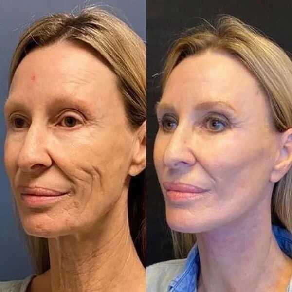 REAFIRMA Y REDUCE TU PAPADA Y ARRUGAS🎁REGALO CREMA PARA DOLORES🎁 ¡Luce Radiante y Siéntete Como Nuevo! 🌟